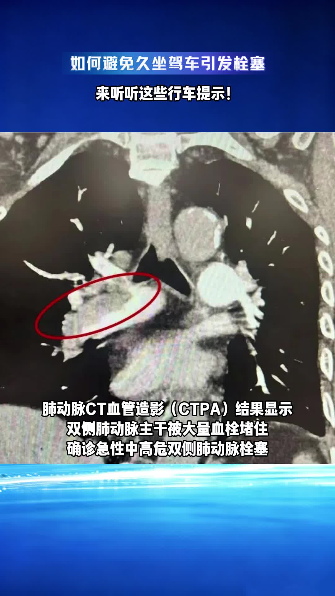 如何避免久坐驾车引发栓塞 来听听这些行车提示